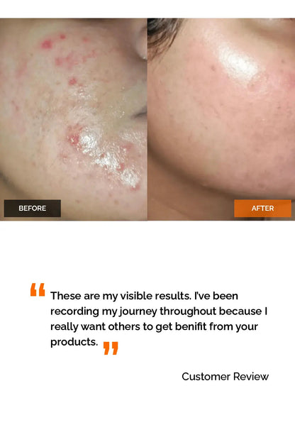 Salicylic Acid 2% Gel Cleanser