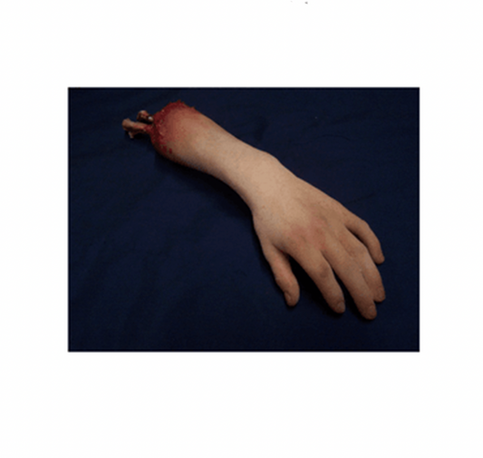 Exposed Bone April Arm
